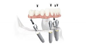 Oral Implant Implantation